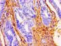 Immunohistochemistry of paraffin-embedded human colon cancer using CAC11217 at dilution of 1:100 Immunohistochemistry of paraffin-embedded human colon cancer using CAC11217 at dilution of 1:100