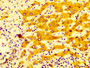 IHC image diluted at 1:400 and staining in paraffin-embedded human liver cancer performed on a Leica BondTM system. After dewaxing and hydration, antigen retrieval was mediated by high pressure in a citrate buffer (pH 6.0). Section was blocked with 10% normal goat serum 30min at RT. Then primary antibody (1% BSA) was incubated at 4°C overnight. The primary is detected by a biotinylated secondary antibody and visualized using an HRP conjugated SP system. IHC image diluted at 1:400 and staining in paraffin-embedded human liver cancer performed on a Leica BondTM system. After dewaxing and hydration, antigen retrieval was mediated by high pressure in a citrate buffer (pH 6.0). Section was blocked with 10% normal goat serum 30min at RT. Then primary antibody (1% BSA) was incubated at 4°C overnight. The primary is detected by a biotinylated secondary antibody and visualized using an HRP conjugated SP system.
