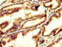 IHC image diluted at 1:200 and staining in paraffin-embedded human prostate tissue performed on a Leica BondTM system. After dewaxing and hydration, antigen retrieval was mediated by high pressure in a citrate buffer (pH 6.0). Section was blocked with 10% normal goat serum 30min at RT. Then primary antibody (1% BSA) was incubated at 4°C overnight. The primary is detected by a biotinylated secondary antibody and visualized using an HRP conjugated SP system. IHC image diluted at 1:200 and staining in paraffin-embedded human prostate tissue performed on a Leica BondTM system. After dewaxing and hydration, antigen retrieval was mediated by high pressure in a citrate buffer (pH 6.0). Section was blocked with 10% normal goat serum 30min at RT. Then primary antibody (1% BSA) was incubated at 4°C overnight. The primary is detected by a biotinylated secondary antibody and visualized using an HRP conjugated SP system.