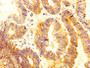 IHC image diluted at 1:300 and staining in paraffin-embedded human colon cancer performed on a Leica BondTM system. After dewaxing and hydration, antigen retrieval was mediated by high pressure in a citrate buffer (pH 6.0). Section was blocked with 10% normal goat serum 30min at RT. Then primary antibody (1% BSA) was incubated at 4°C overnight. The primary is detected by a biotinylated secondary antibody and visualized using an HRP conjugated SP system. IHC image diluted at 1:300 and staining in paraffin-embedded human colon cancer performed on a Leica BondTM system. After dewaxing and hydration, antigen retrieval was mediated by high pressure in a citrate buffer (pH 6.0). Section was blocked with 10% normal goat serum 30min at RT. Then primary antibody (1% BSA) was incubated at 4°C overnight. The primary is detected by a biotinylated secondary antibody and visualized using an HRP conjugated SP system.