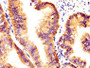 IHC image diluted at 1:400 and staining in paraffin-embedded human endometrial cancer performed on a Leica BondTM system. After dewaxing and hydration, antigen retrieval was mediated by high pressure in a citrate buffer (pH 6.0). Section was blocked with 10% normal goat serum 30min at RT. Then primary antibody (1% BSA) was incubated at 4°C overnight. The primary is detected by a biotinylated secondary antibody and visualized using an HRP conjugated SP system. IHC image diluted at 1:400 and staining in paraffin-embedded human endometrial cancer performed on a Leica BondTM system. After dewaxing and hydration, antigen retrieval was mediated by high pressure in a citrate buffer (pH 6.0). Section was blocked with 10% normal goat serum 30min at RT. Then primary antibody (1% BSA) was incubated at 4°C overnight. The primary is detected by a biotinylated secondary antibody and visualized using an HRP conjugated SP system.