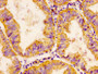 IHC image diluted at 1:200 and staining in paraffin-embedded human endometrial cancer performed on a Leica BondTM system. After dewaxing and hydration, antigen retrieval was mediated by high pressure in a citrate buffer (pH 6.0). Section was blocked with 10% normal goat serum 30min at RT. Then primary antibody (1% BSA) was incubated at 4°C overnight. The primary is detected by a biotinylated secondary antibody and visualized using an HRP conjugated SP system. IHC image diluted at 1:200 and staining in paraffin-embedded human endometrial cancer performed on a Leica BondTM system. After dewaxing and hydration, antigen retrieval was mediated by high pressure in a citrate buffer (pH 6.0). Section was blocked with 10% normal goat serum 30min at RT. Then primary antibody (1% BSA) was incubated at 4°C overnight. The primary is detected by a biotinylated secondary antibody and visualized using an HRP conjugated SP system.
