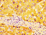 IHC image diluted at 1:100 and staining in paraffin-embedded human liver tissue performed on a Leica BondTM system. After dewaxing and hydration, antigen retrieval was mediated by high pressure in a citrate buffer (pH 6.0). Section was blocked with 10% normal goat serum 30min at RT. Then primary antibody (1% BSA) was incubated at 4°C overnight. The primary is detected by a biotinylated secondary antibody and visualized using an HRP conjugated SP system. IHC image diluted at 1:100 and staining in paraffin-embedded human liver tissue performed on a Leica BondTM system. After dewaxing and hydration, antigen retrieval was mediated by high pressure in a citrate buffer (pH 6.0). Section was blocked with 10% normal goat serum 30min at RT. Then primary antibody (1% BSA) was incubated at 4°C overnight. The primary is detected by a biotinylated secondary antibody and visualized using an HRP conjugated SP system.
