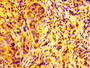 IHC image diluted at 1:100 and staining in paraffin-embedded human pancreatic cancer performed on a Leica BondTM system. After dewaxing and hydration, antigen retrieval was mediated by high pressure in a citrate buffer (pH 6.0). Section was blocked with 10% normal goat serum 30min at RT. Then primary antibody (1% BSA) was incubated at 4°C overnight. The primary is detected by a biotinylated secondary antibody and visualized using an HRP conjugated SP system. IHC image diluted at 1:100 and staining in paraffin-embedded human pancreatic cancer performed on a Leica BondTM system. After dewaxing and hydration, antigen retrieval was mediated by high pressure in a citrate buffer (pH 6.0). Section was blocked with 10% normal goat serum 30min at RT. Then primary antibody (1% BSA) was incubated at 4°C overnight. The primary is detected by a biotinylated secondary antibody and visualized using an HRP conjugated SP system.