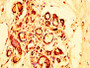 IHC image diluted at 1:300 and staining in paraffin-embedded human breast cancer performed on a Leica BondTM system. After dewaxing and hydration, antigen retrieval was mediated by high pressure in a citrate buffer (pH 6.0). Section was blocked with 10% normal goat serum 30min at RT. Then primary antibody (1% BSA) was incubated at 4°C overnight. The primary is detected by a biotinylated secondary antibody and visualized using an HRP conjugated SP system.