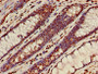 Immunohistochemistry of paraffin-embedded human colon cancer using CAC11292 at dilution of 1:100