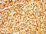 Immunohistochemistry of paraffin-embedded human colon cancer using CAC11298 at dilution of 1:100