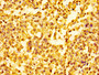 Immunohistochemistry of paraffin-embedded human colon cancer using CAC11299 at dilution of 1:100