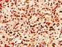 IHC image diluted at 1:50 and staining in paraffin-embedded human glioma performed on a Leica BondTM system. After dewaxing and hydration, antigen retrieval was mediated by high pressure in a citrate buffer (pH 6.0). Section was blocked with 10% normal goat serum 30min at RT. Then primary antibody (1% BSA) was incubated at 4°C overnight. The primary is detected by a biotinylated secondary antibody and visualized using an HRP conjugated SP system.