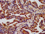 IHC image diluted at 1:400 and staining in paraffin-embedded human lung cancer performed on a Leica BondTM system. After dewaxing and hydration, antigen retrieval was mediated by high pressure in a citrate buffer (pH 6.0). Section was blocked with 10% normal goat serum 30min at RT. Then primary antibody (1% BSA) was incubated at 4°C overnight. The primary is detected by a biotinylated secondary antibody and visualized using an HRP conjugated SP system.