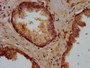 IHC image diluted at 1:400 and staining in paraffin-embedded human prostate cancer performed on a Leica BondTM system. After dewaxing and hydration, antigen retrieval was mediated by high pressure in a citrate buffer (pH 6.0). Section was blocked with 10% normal goat serum 30min at RT. Then primary antibody (1% BSA) was incubated at 4°C overnight. The primary is detected by a biotinylated secondary antibody and visualized using an HRP conjugated SP system.