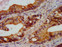 IHC image diluted at 1:300 and staining in paraffin-embedded human colon cancer performed on a Leica BondTM system. After dewaxing and hydration, antigen retrieval was mediated by high pressure in a citrate buffer (pH 6.0). Section was blocked with 10% normal goat serum 30min at RT. Then primary antibody (1% BSA) was incubated at 4°C overnight. The primary is detected by a biotinylated secondary antibody and visualized using an HRP conjugated SP system.