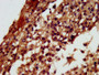 IHC image diluted at 1:300 and staining in paraffin-embedded human melanoma performed on a Leica BondTM system. After dewaxing and hydration, antigen retrieval was mediated by high pressure in a citrate buffer (pH 6.0). Section was blocked with 10% normal goat serum 30min at RT. Then primary antibody (1% BSA) was incubated at 4°C overnight. The primary is detected by a biotinylated secondary antibody and visualized using an HRP conjugated SP system.
