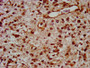 IHC image diluted at 1:400 and staining in paraffin-embedded human glioma performed on a Leica BondTM system. After dewaxing and hydration, antigen retrieval was mediated by high pressure in a citrate buffer (pH 6.0). Section was blocked with 10% normal goat serum 30min at RT. Then primary antibody (1% BSA) was incubated at 4°C overnight. The primary is detected by a biotinylated secondary antibody and visualized using an HRP conjugated SP system.