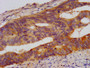 IHC image diluted at 1:500 and staining in paraffin-embedded human colon cancer performed on a Leica BondTM system. After dewaxing and hydration, antigen retrieval was mediated by high pressure in a citrate buffer (pH 6.0). Section was blocked with 10% normal goat serum 30min at RT. Then primary antibody (1% BSA) was incubated at 4°C overnight. The primary is detected by a biotinylated secondary antibody and visualized using an HRP conjugated SP system. IHC image diluted at 1:500 and staining in paraffin-embedded human colon cancer performed on a Leica BondTM system. After dewaxing and hydration, antigen retrieval was mediated by high pressure in a citrate buffer (pH 6.0). Section was blocked with 10% normal goat serum 30min at RT. Then primary antibody (1% BSA) was incubated at 4°C overnight. The primary is detected by a biotinylated secondary antibody and visualized using an HRP conjugated SP system.