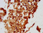 IHC image of CAC11350 diluted at 1:100 and staining in paraffin-embedded human melanoma performed on a Leica BondTM system. After dewaxing and hydration, antigen retrieval was mediated by high pressure in a citrate buffer (pH 6.0). Section was blocked with 10% normal goat serum 30min at RT. Then primary antibody (1% BSA) was incubated at 4°C overnight. The primary is detected by a biotinylated secondary antibody and visualized using an HRP conjugated SP system.