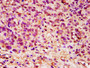 IHC image diluted at 1:200 and staining in paraffin-embedded human ovarian cancer performed on a Leica BondTM system. After dewaxing and hydration, antigen retrieval was mediated by high pressure in a citrate buffer (pH 6.0). Section was blocked with 10% normal goat serum 30min at RT. Then primary antibody (1% BSA) was incubated at 4°C overnight. The primary is detected by a biotinylated secondary antibody and visualized using an HRP conjugated SP system.