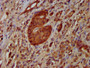 IHC image diluted at 1:100 and staining in paraffin-embedded human pancreatic cancer performed on a Leica BondTM system. After dewaxing and hydration, antigen retrieval was mediated by high pressure in a citrate buffer (pH 6.0). Section was blocked with 10% normal goat serum 30min at RT. Then primary antibody (1% BSA) was incubated at 4°C overnight. The primary is detected by a biotinylated secondary antibody and visualized using an HRP conjugated SP system.