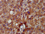 IHC image diluted at 1:500 and staining in paraffin-embedded human liver tissue performed on a Leica BondTM system. After dewaxing and hydration, antigen retrieval was mediated by high pressure in a citrate buffer (pH 6.0). Section was blocked with 10% normal goat serum 30min at RT. Then primary antibody (1% BSA) was incubated at 4°C overnight. The primary is detected by a biotinylated secondary antibody and visualized using an HRP conjugated SP system.