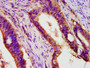 IHC image diluted at 1:400 and staining in paraffin-embedded human colon cancer performed on a Leica BondTM system. After dewaxing and hydration, antigen retrieval was mediated by high pressure in a citrate buffer (pH 6.0). Section was blocked with 10% normal goat serum 30min at RT. Then primary antibody (1% BSA) was incubated at 4°C overnight. The primary is detected by a biotinylated secondary antibody and visualized using an HRP conjugated SP system.