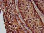 IHC image diluted at 1:600 and staining in paraffin-embedded human lung cancer performed on a Leica BondTM system. After dewaxing and hydration, antigen retrieval was mediated by high pressure in a citrate buffer (pH 6.0). Section was blocked with 10% normal goat serum 30min at RT. Then primary antibody (1% BSA) was incubated at 4°C overnight. The primary is detected by a biotinylated secondary antibody and visualized using an HRP conjugated SP system.