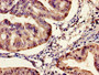 Immunohistochemistry of paraffin-embedded human endometrial cancer using CAC11407 at dilution of 1:100