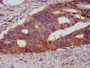 IHC image of CAC11420 diluted at 1:500 and staining in paraffin-embedded human colon cancer performed on a Leica BondTM system. After dewaxing and hydration, antigen retrieval was mediated by high pressure in a citrate buffer (pH 6.0). Section was blocked with 10% normal goat serum 30min at RT. Then primary antibody (1% BSA) was incubated at 4°C overnight. The primary is detected by a biotinylated secondary antibody and visualized using an HRP conjugated SP system.