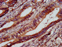 IHC image diluted at 1:1000 and staining in paraffin-embedded human colon cancer performed on a Leica BondTM system. After dewaxing and hydration, antigen retrieval was mediated by high pressure in a citrate buffer (pH 6.0). Section was blocked with 10% normal goat serum 30min at RT. Then primary antibody (1% BSA) was incubated at 4°C overnight. The primary is detected by a biotinylated secondary antibody and visualized using an HRP conjugated SP system.