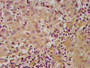 IHC image diluted at 1:600 and staining in paraffin-embedded human liver cancer performed on a Leica BondTM system. After dewaxing and hydration, antigen retrieval was mediated by high pressure in a citrate buffer (pH 6.0). Section was blocked with 10% normal goat serum 30min at RT. Then primary antibody (1% BSA) was incubated at 4°C overnight. The primary is detected by a biotinylated secondary antibody and visualized using an HRP conjugated SP system.