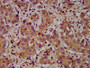 IHC image diluted at 1:400 and staining in paraffin-embedded human liver cancer performed on a Leica BondTM system. After dewaxing and hydration, antigen retrieval was mediated by high pressure in a citrate buffer (pH 6.0). Section was blocked with 10% normal goat serum 30min at RT. Then primary antibody (1% BSA) was incubated at 4°C overnight. The primary is detected by a biotinylated secondary antibody and visualized using an HRP conjugated SP system.