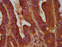 IHC image diluted at 1:500 and staining in paraffin-embedded human colon cancer performed on a Leica BondTM system. After dewaxing and hydration, antigen retrieval was mediated by high pressure in a citrate buffer (pH 6.0). Section was blocked with 10% normal goat serum 30min at RT. Then primary antibody (1% BSA) was incubated at 4°C overnight. The primary is detected by a biotinylated secondary antibody and visualized using an HRP conjugated SP system.