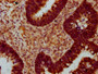 IHC image of CAC11444 diluted at 1:400 and staining in paraffin-embedded human ovarian cancer performed on a Leica BondTM system. After dewaxing and hydration, antigen retrieval was mediated by high pressure in a citrate buffer (pH 6.0). Section was blocked with 10% normal goat serum 30min at RT. Then primary antibody (1% BSA) was incubated at 4°C overnight. The primary is detected by a biotinylated secondary antibody and visualized using an HRP conjugated SP system.