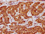 IHC image diluted at 1:200 and staining in paraffin-embedded human liver cancer performed on a Leica BondTM system. After dewaxing and hydration, antigen retrieval was mediated by high pressure in a citrate buffer (pH 6.0). Section was blocked with 10% normal goat serum 30min at RT. Then primary antibody (1% BSA) was incubated at 4°C overnight. The primary is detected by a biotinylated secondary antibody and visualized using an HRP conjugated SP system.