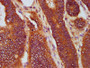 IHC image diluted at 1:400 and staining in paraffin-embedded human colon cancer performed on a Leica BondTM system. After dewaxing and hydration, antigen retrieval was mediated by high pressure in a citrate buffer (pH 6.0). Section was blocked with 10% normal goat serum 30min at RT. Then primary antibody (1% BSA) was incubated at 4°C overnight. The primary is detected by a biotinylated secondary antibody and visualized using an HRP conjugated SP system.