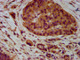 IHC image diluted at 1:400 and staining in paraffin-embedded human pancreatic cancer performed on a Leica BondTM system. After dewaxing and hydration, antigen retrieval was mediated by high pressure in a citrate buffer (pH 6.0). Section was blocked with 10% normal goat serum 30min at RT. Then primary antibody (1% BSA) was incubated at 4°C overnight. The primary is detected by a biotinylated secondary antibody and visualized using an HRP conjugated SP system.