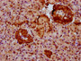 IHC image diluted at 1:600 and staining in paraffin-embedded human pancreatic tissue performed on a Leica BondTM system. After dewaxing and hydration, antigen retrieval was mediated by high pressure in a citrate buffer (pH 6.0). Section was blocked with 10% normal goat serum 30min at RT. Then primary antibody (1% BSA) was incubated at 4°C overnight. The primary is detected by a biotinylated secondary antibody and visualized using an HRP conjugated SP system. IHC image diluted at 1:600 and staining in paraffin-embedded human pancreatic tissue performed on a Leica BondTM system. After dewaxing and hydration, antigen retrieval was mediated by high pressure in a citrate buffer (pH 6.0). Section was blocked with 10% normal goat serum 30min at RT. Then primary antibody (1% BSA) was incubated at 4°C overnight. The primary is detected by a biotinylated secondary antibody and visualized using an HRP conjugated SP system.
