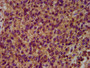 IHC image diluted at 1:500 and staining in paraffin-embedded human glioma performed on a Leica BondTM system. After dewaxing and hydration, antigen retrieval was mediated by high pressure in a citrate buffer (pH 6.0). Section was blocked with 10% normal goat serum 30min at RT. Then primary antibody (1% BSA) was incubated at 4°C overnight. The primary is detected by a biotinylated secondary antibody and visualized using an HRP conjugated SP system.