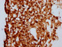 IHC image diluted at 1:500 and staining in paraffin-embedded human melanoma performed on a Leica BondTM system. After dewaxing and hydration, antigen retrieval was mediated by high pressure in a citrate buffer (pH 6.0). Section was blocked with 10% normal goat serum 30min at RT. Then primary antibody (1% BSA) was incubated at 4°C overnight. The primary is detected by a biotinylated secondary antibody and visualized using an HRP conjugated SP system.