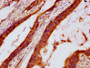 IHC image diluted at 1:600 and staining in paraffin-embedded human colon cancer performed on a Leica BondTM system. After dewaxing and hydration, antigen retrieval was mediated by high pressure in a citrate buffer (pH 6.0). Section was blocked with 10% normal goat serum 30min at RT. Then primary antibody (1% BSA) was incubated at 4°C overnight. The primary is detected by a biotinylated secondary antibody and visualized using an HRP conjugated SP system. IHC image diluted at 1:600 and staining in paraffin-embedded human colon cancer performed on a Leica BondTM system. After dewaxing and hydration, antigen retrieval was mediated by high pressure in a citrate buffer (pH 6.0). Section was blocked with 10% normal goat serum 30min at RT. Then primary antibody (1% BSA) was incubated at 4°C overnight. The primary is detected by a biotinylated secondary antibody and visualized using an HRP conjugated SP system.