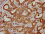 IHC image diluted at 1:300 and staining in paraffin-embedded human liver cancer performed on a Leica BondTM system. After dewaxing and hydration, antigen retrieval was mediated by high pressure in a citrate buffer (pH 6.0). Section was blocked with 10% normal goat serum 30min at RT. Then primary antibody (1% BSA) was incubated at 4°C overnight. The primary is detected by a biotinylated secondary antibody and visualized using an HRP conjugated SP system.