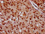 IHC image diluted at 1:400 and staining in paraffin-embedded human glioma performed on a Leica BondTM system. After dewaxing and hydration, antigen retrieval was mediated by high pressure in a citrate buffer (pH 6.0). Section was blocked with 10% normal goat serum 30min at RT. Then primary antibody (1% BSA) was incubated at 4°C overnight. The primary is detected by a biotinylated secondary antibody and visualized using an HRP conjugated SP system.