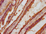 IHC image diluted at 1:100 and staining in paraffin-embedded human colon cancer performed on a Leica BondTM system. After dewaxing and hydration, antigen retrieval was mediated by high pressure in a citrate buffer (pH 6.0). Section was blocked with 10% normal goat serum 30min at RT. Then primary antibody (1% BSA) was incubated at 4°C overnight. The primary is detected by a biotinylated secondary antibody and visualized using an HRP conjugated SP system.