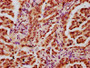 IHC image diluted at 1:20 and staining in paraffin-embedded human lung cancer performed on a Leica BondTM system. After dewaxing and hydration, antigen retrieval was mediated by high pressure in a citrate buffer (pH 6.0). Section was blocked with 10% normal goat serum 30min at RT. Then primary antibody (1% BSA) was incubated at 4°C overnight. The primary is detected by a biotinylated secondary antibody and visualized using an HRP conjugated SP system.