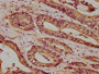IHC image diluted at 1:100 and staining in paraffin-embedded human colon cancer performed on a Leica BondTM system. After dewaxing and hydration, antigen retrieval was mediated by high pressure in a citrate buffer (pH 6.0). Section was blocked with 10% normal goat serum 30min at RT. Then primary antibody (1% BSA) was incubated at 4°C overnight. The primary is detected by a biotinylated secondary antibody and visualized using an HRP conjugated SP system.
