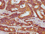 IHC image diluted at 1:300 and staining in paraffin-embedded human colon cancer performed on a Leica BondTM system. After dewaxing and hydration, antigen retrieval was mediated by high pressure in a citrate buffer (pH 6.0). Section was blocked with 10% normal goat serum 30min at RT. Then primary antibody (1% BSA) was incubated at 4°C overnight. The primary is detected by a biotinylated secondary antibody and visualized using an HRP conjugated SP system.