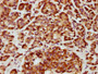 IHC image diluted at 1:800 and staining in paraffin-embedded human pancreatic cancer performed on a Leica BondTM system. After dewaxing and hydration, antigen retrieval was mediated by high pressure in a citrate buffer (pH 6.0). Section was blocked with 10% normal goat serum 30min at RT. Then primary antibody (1% BSA) was incubated at 4°C overnight. The primary is detected by a biotinylated secondary antibody and visualized using an HRP conjugated SP system.