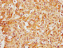 IHC image of CAC11593 diluted at 1:400 and staining in paraffin-embedded human liver cancer performed on a Leica BondTM system. After dewaxing and hydration, antigen retrieval was mediated by high pressure in a citrate buffer (pH 6.0). Section was blocked with 10% normal goat serum 30min at RT. Then primary antibody (1% BSA) was incubated at 4°C overnight. The primary is detected by a biotinylated secondary antibody and visualized using an HRP conjugated SP system.