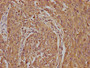 IHC image diluted at 1:100 and staining in paraffin-embedded human cervical cancer performed on a Leica BondTM system. After dewaxing and hydration, antigen retrieval was mediated by high pressure in a citrate buffer (pH 6.0). Section was blocked with 10% normal goat serum 30min at RT. Then primary antibody (1% BSA) was incubated at 4°C overnight. The primary is detected by a biotinylated secondary antibody and visualized using an HRP conjugated SP system.