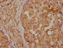 IHC image of CAC11661 diluted at 1:400 and staining in paraffin-embedded human breast cancer performed on a Leica BondTM system. After dewaxing and hydration, antigen retrieval was mediated by high pressure in a citrate buffer (pH 6.0). Section was blocked with 10% normal goat serum 30min at RT. Then primary antibody (1% BSA) was incubated at 4°C overnight. The primary is detected by a biotinylated secondary antibody and visualized using an HRP conjugated SP system.