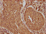 IHC image of CAC11670 diluted at 1:100 and staining in paraffin-embedded human cervical cancer performed on a Leica BondTM system. After dewaxing and hydration, antigen retrieval was mediated by high pressure in a citrate buffer (pH 6.0). Section was blocked with 10% normal goat serum 30min at RT. Then primary antibody (1% BSA) was incubated at 4°C overnight. The primary is detected by a biotinylated secondary antibody and visualized using an HRP conjugated SP system.